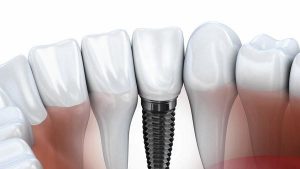 photo dental implant